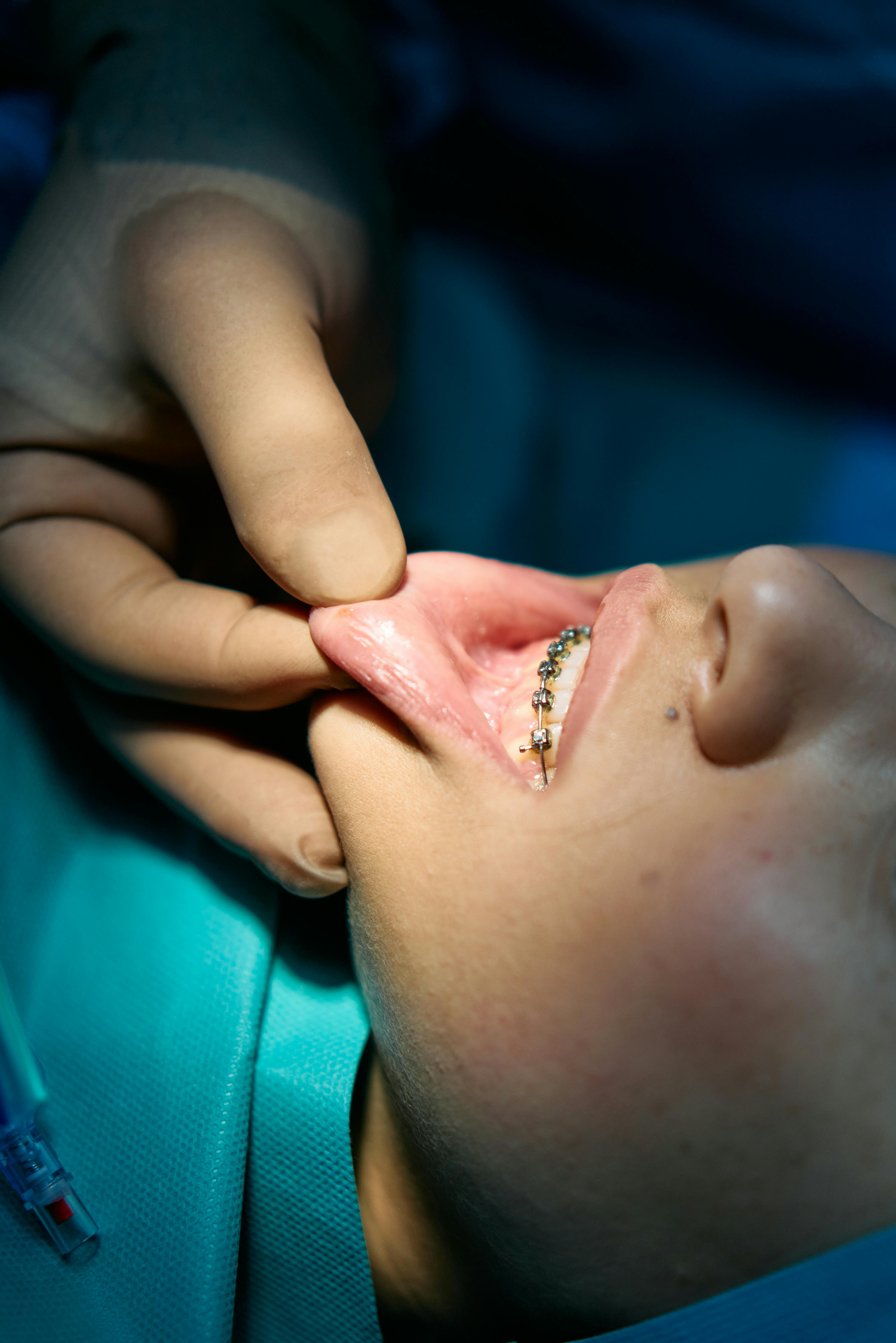 Pose d’appareil orthodontique